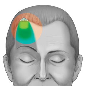 Endotine Forehead-mini device in forehead