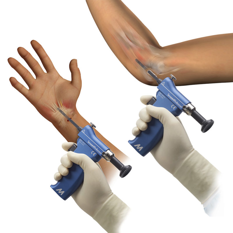 SmartRelease® Upper Extremity System
