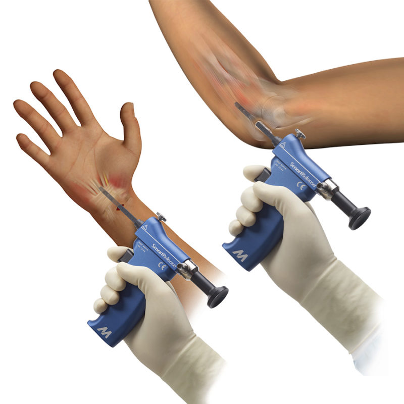 SmartRelease carpal and cubital tunnel procedures