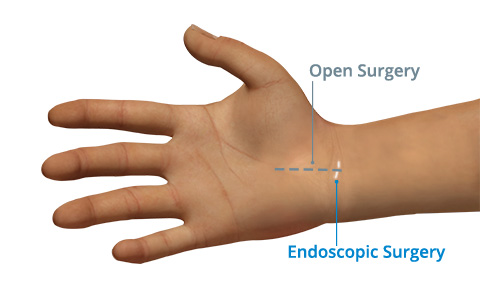 Single-portal Endoscopic Surgery